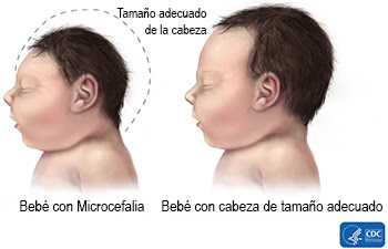 Comparación gráfica entre la cabeza de un bebé afectado por la Microcefalia (izquierda) y un bebé normal.