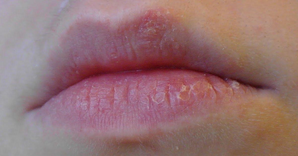 fluores: What EOS lipbalm did to my lips (rash/blister and  
