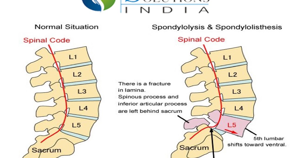 Spine Solutions India by Dr Sudeep Jain Understanding spinal problem