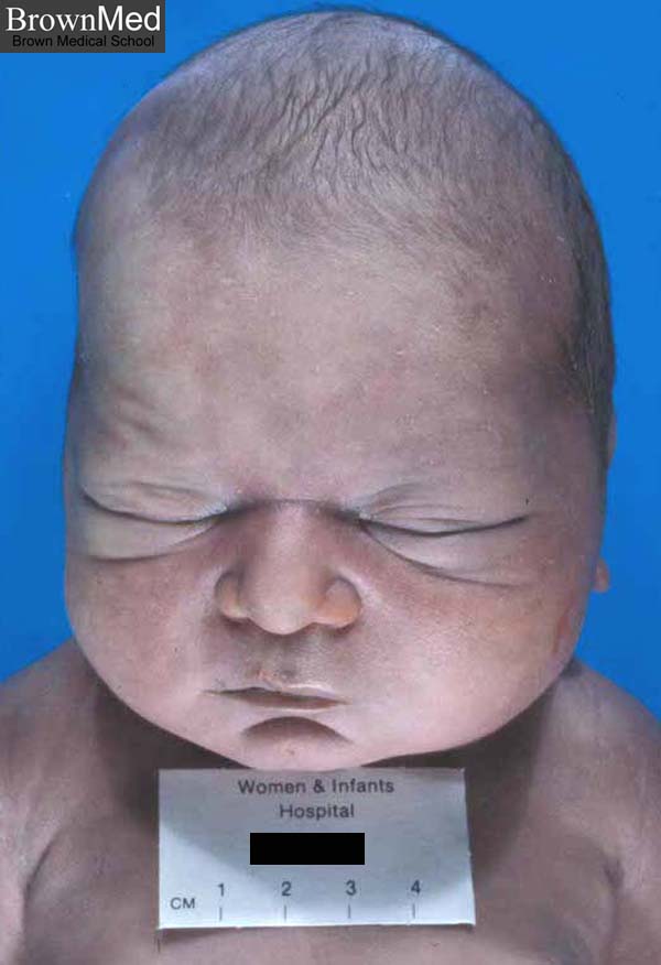 SINDROME DE POTTER DISCUSIÓN DEL CASO CLINICO