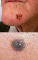 malignant melanoma pictures