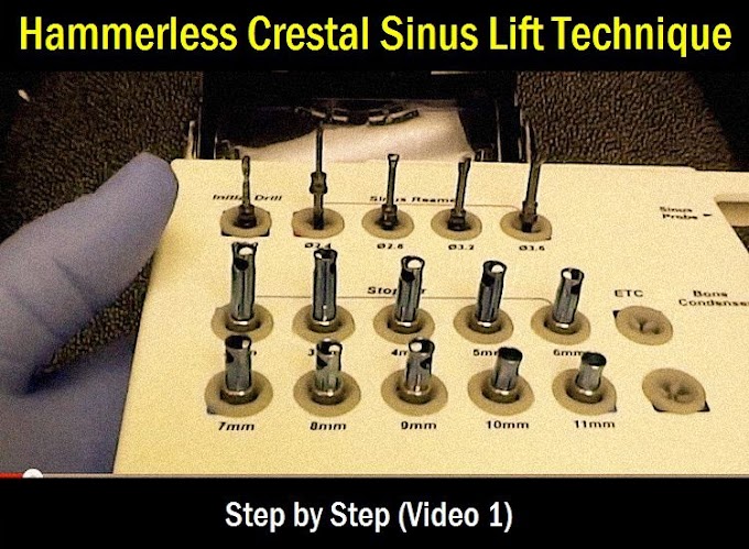IMPLANTOLOGY: Hammerless Crestal Sinus Lift Technique - Step by Step (Video 1)