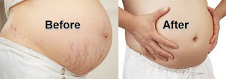 How to Remove Stretch Marks Quickly: 8 Secret Natural Remedies