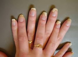 early stage nail psoriasis severity index