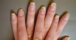 napsi nail psoriasis severity index hogyan kezeljük a pikkelysömör áfonyával