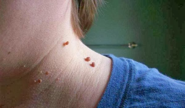 remove-skin-tags-naturally-home-remedies