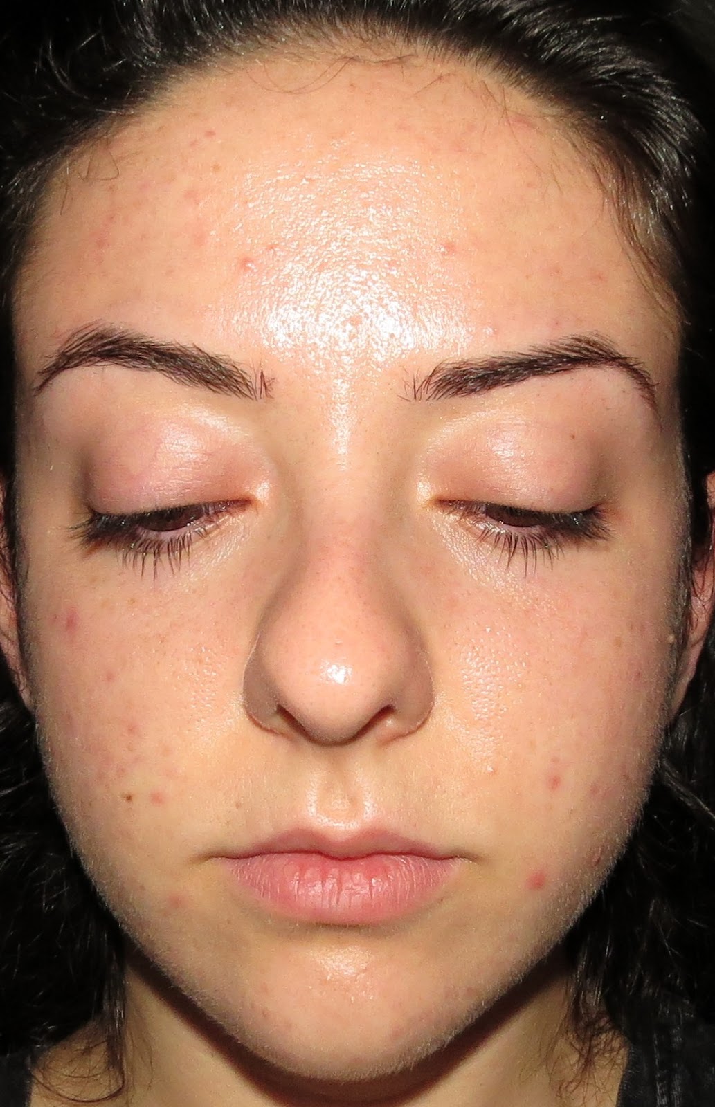 Vitamin C For Acne Scars Before And After