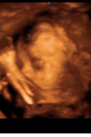 3D Ultrasound - Pregnancy Scan