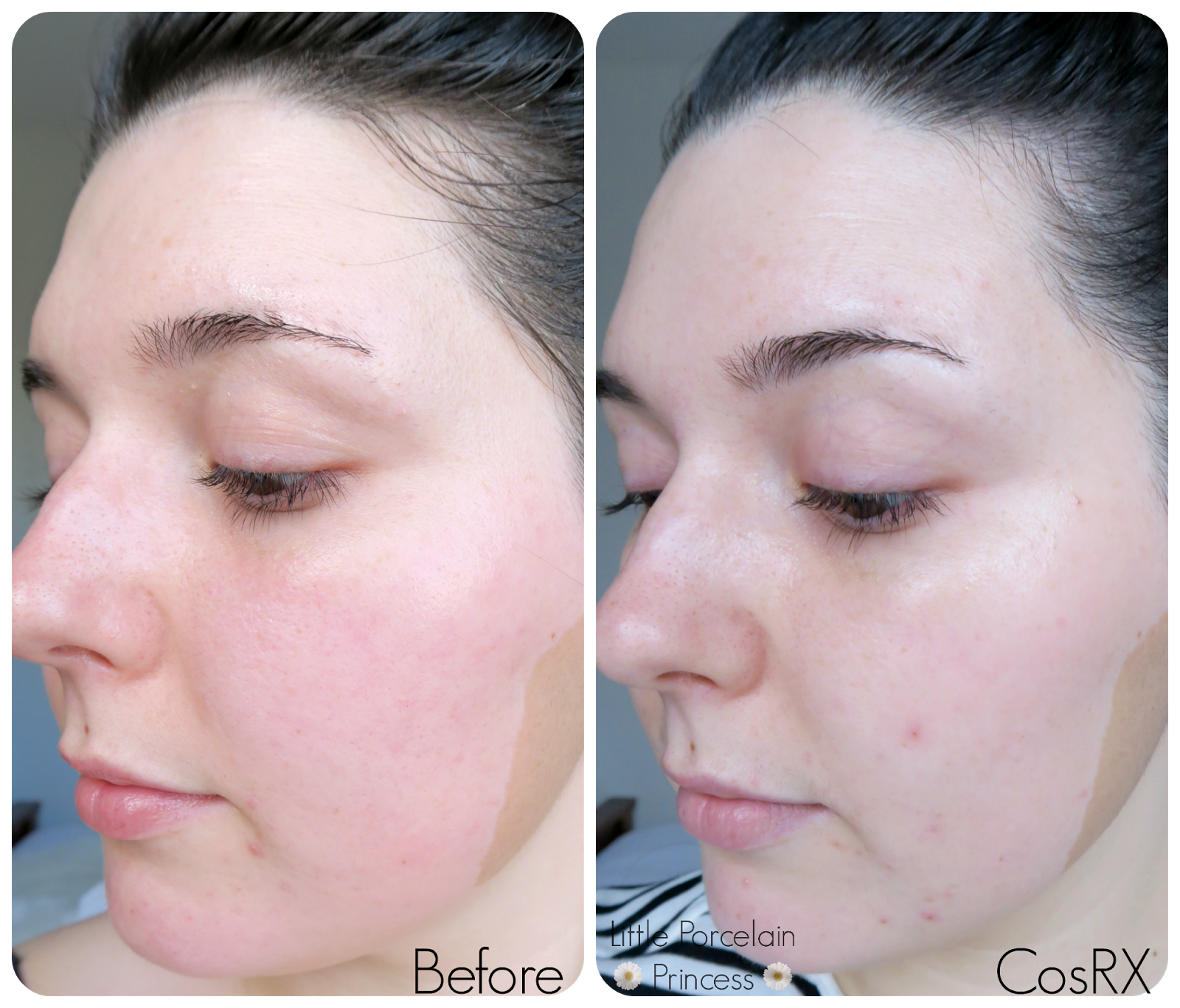 Little Porcelain Princess East VS West CosRX One Step Pimple Clear