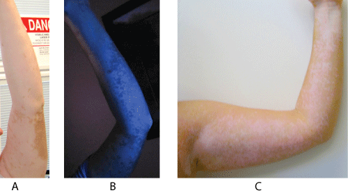 Mejora del vitiligo después del tratamiento del hipotiroidismo-fig-3