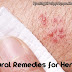 Natural Remedies for Herpes, Cause of Herpes and Treatment