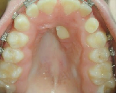Phân biệt răng vĩnh viễn mọc lạc với răng thừa