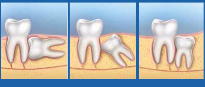  Quy trình nhổ răng khôn như thế nào?