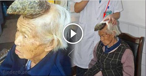 87-Year-Old “Unicorn Woman” Who Has A 13cm Horn Growing Out Of Her Head
