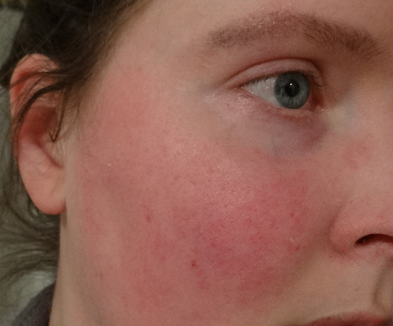 Scarlet Letters, dealing with vascular rosacea, face flushing, burning