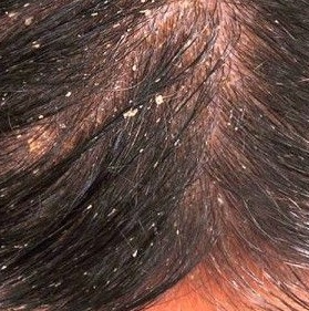 How To Remove Dandruff In A Natural Way Moral Stories