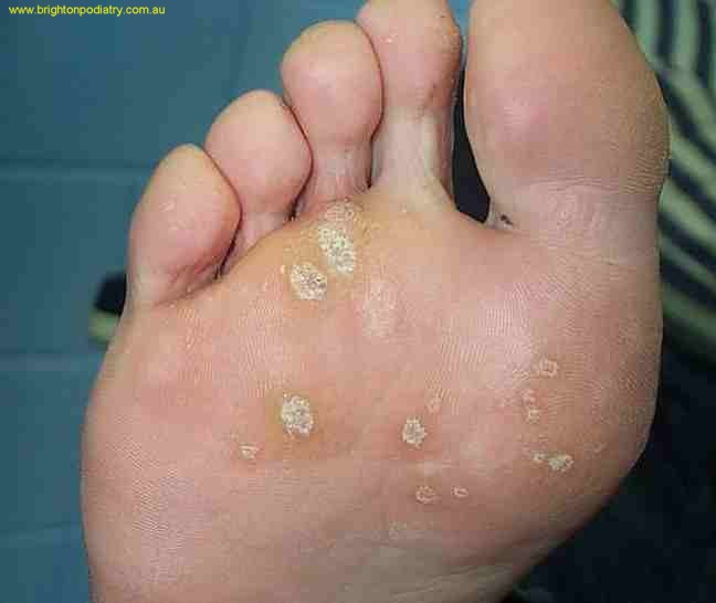 Photos of Foot Warts - Also Known as Plantar Verruca