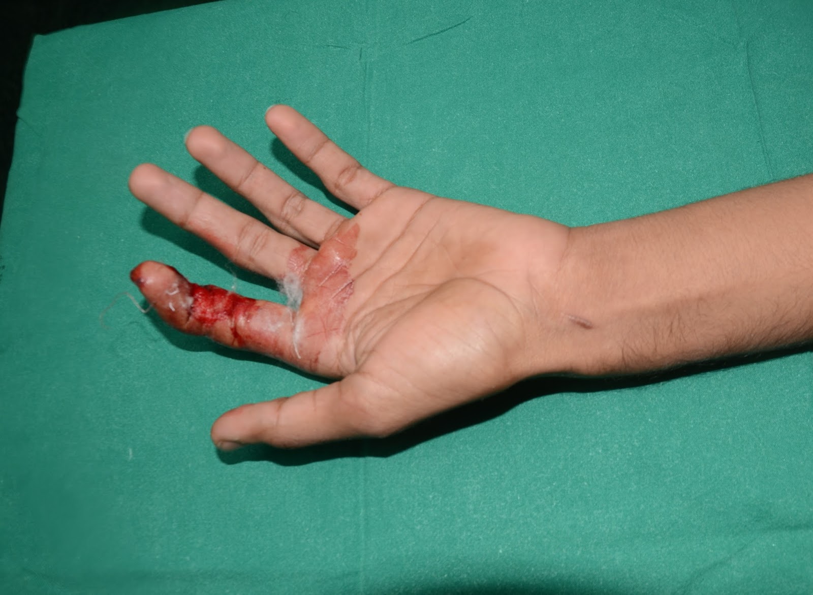Crushed Hand Injury