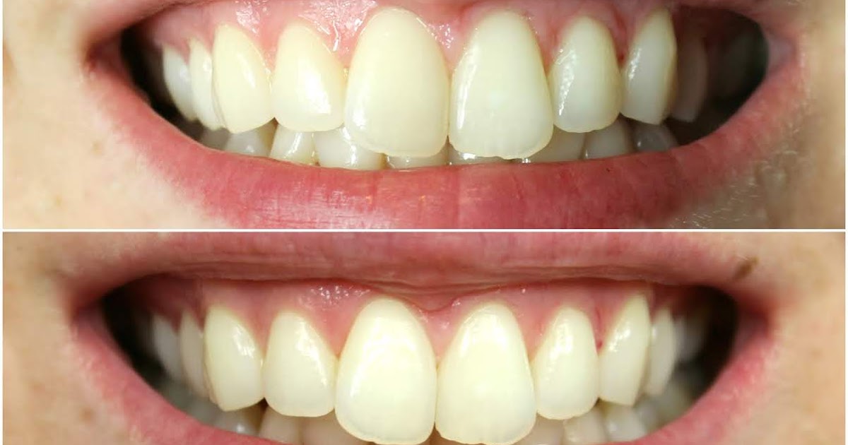 Home teeth whitening kits work