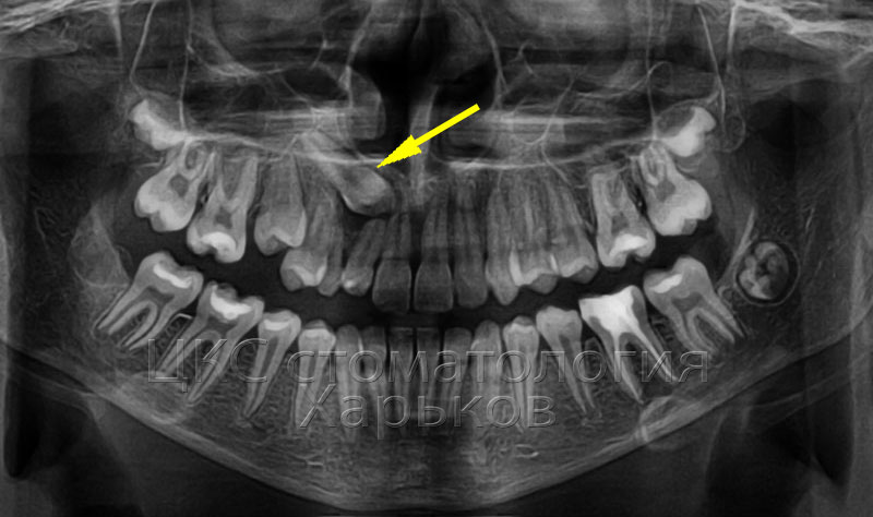 Клык сверху зубов. Ретинированный дистопированный зуб. Ретинированный дистопированный зуб мудрости. Ретинированный клык рентген. Ретенция клыка в верхней челюсти.