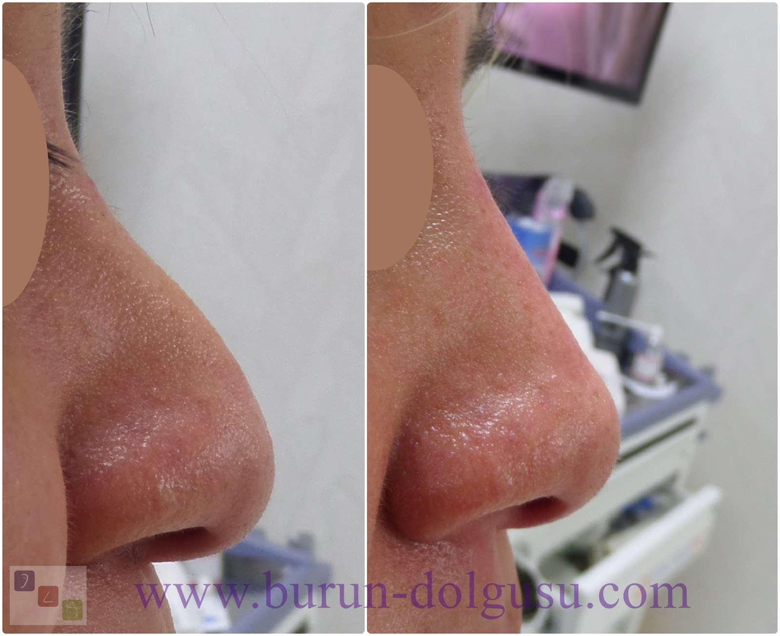 Cost Of Non Surgical Nose Job