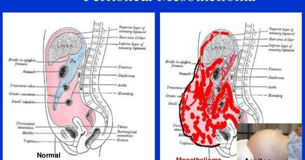 does lung cancer affect respiration