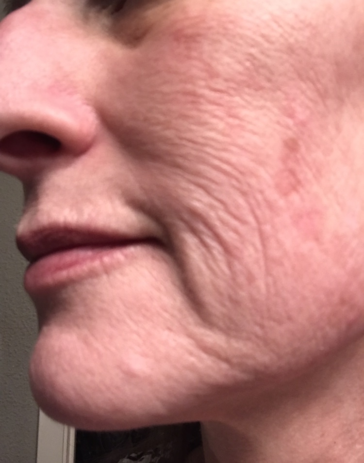 Serotonin affect syndrome accutane treatments how does