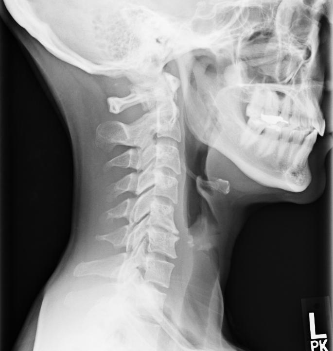 Neck Injury March 2015