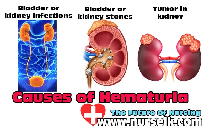What is hematuria? Causes of Hematuria