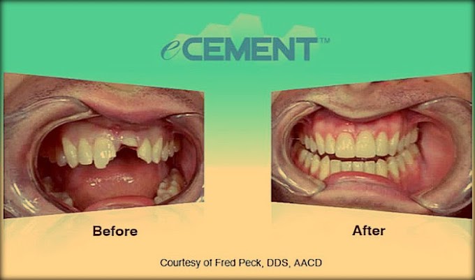 DENTAL MATERIALS: eCEMENT - Bisco Dental