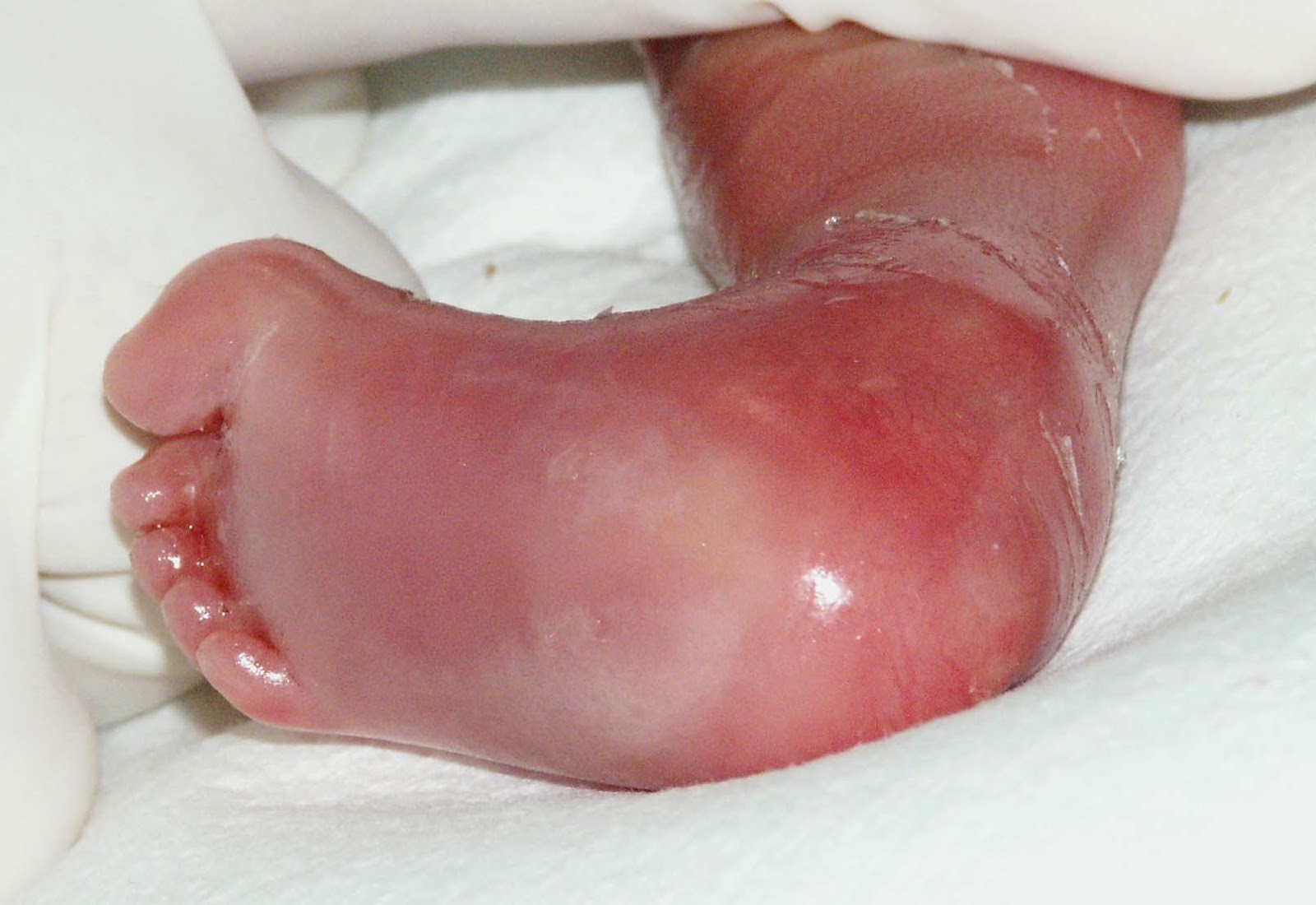 Rare Genetic Disorder: Harlequin Ichthyosis - What is it?