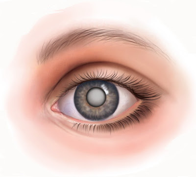 cataract-eye