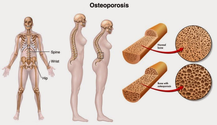 Obat Tradisional Osteoporosis