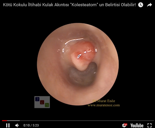 Smelly ear discharge - Malodorous ear discharge - Cholesteatoma - Cholesteatoma treatment - Cholesteatoma Symptoms - Cholesteatoma Definition - Mastoidectomy operation - Ear surgery in Istanbul - Ear surgery in Turkey