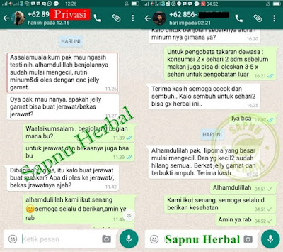 Cara Mengobati Benjolan Sekelan Di Pangkal Paha Secara Alami Cara Mengobati Benjolan Sekelan Di Pangkal Paha Secara Alami