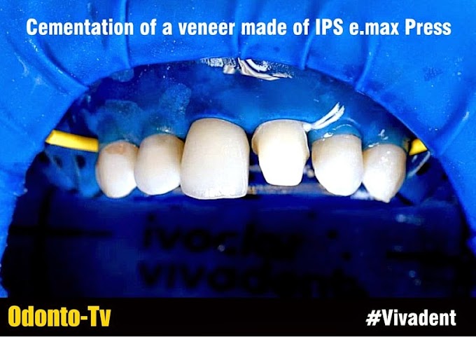 Variolink Esthetic LC: Cementation of a veneer made of IPS e.max Press - Vivadent