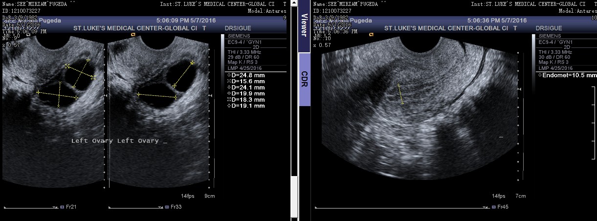 Mature Follicle Size At Ovulation 70