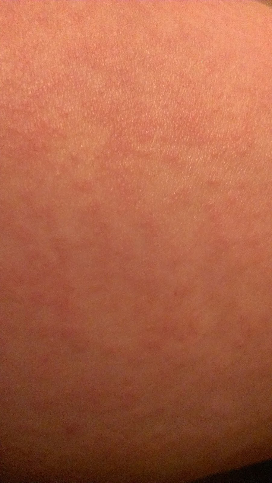 Another Day... Keratosis Pilaris update after 4 days of treatment