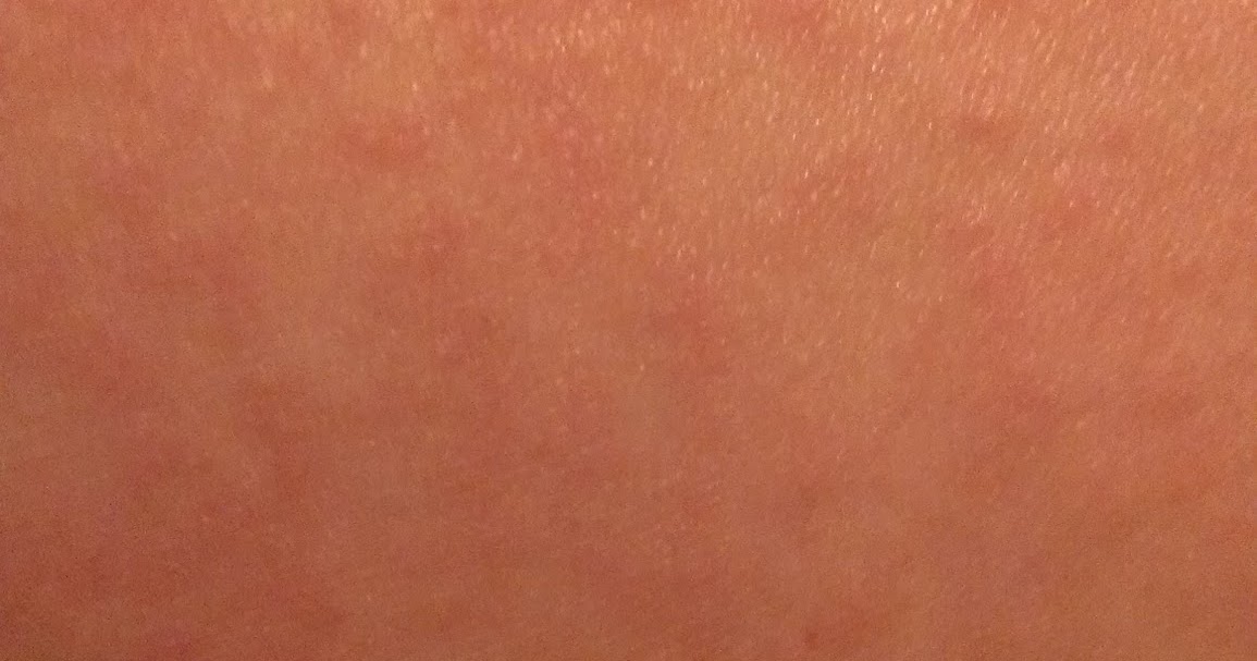 Another Day Keratosis Pilaris Update After 4 Days Of Treatment