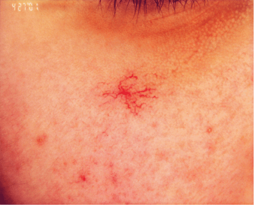 Dermnet: Dermatology Pictures - Skin Disease Pictures