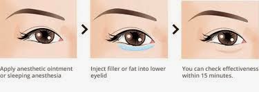 ถุงใต้ตา