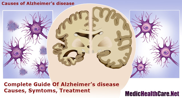 Causes of Alzheimer’s disease