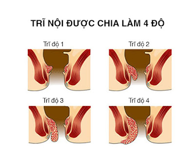 BỆNH TRĨ NỘI CẤP ĐỘ 2 UỐNG THUỐC GÌ HIỆU QUẢ