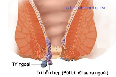 Hình ảnh bệnh trĩ hỗn hợp