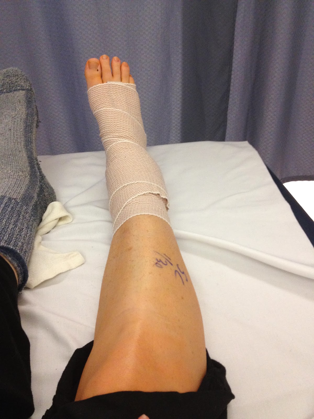 What to Expect When You Break Your Ankle ankle hardware removal