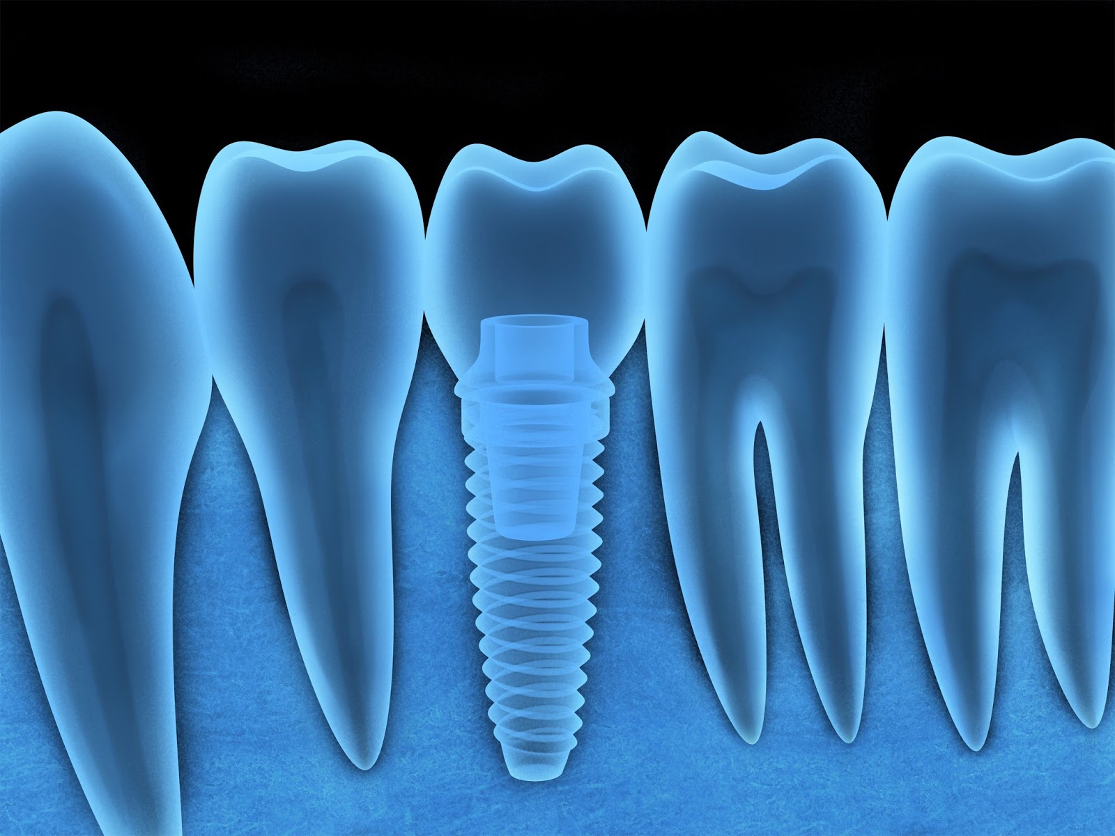 Solace Oral Surgery Benefits of Dental Implants