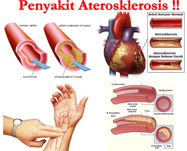 Cara Menyembuhkan Aterosklerosis Secara Alami - Kesehatan Kita