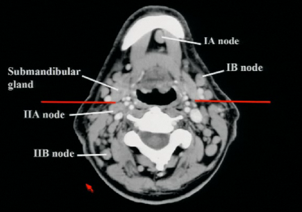 rsna: cervical LNs