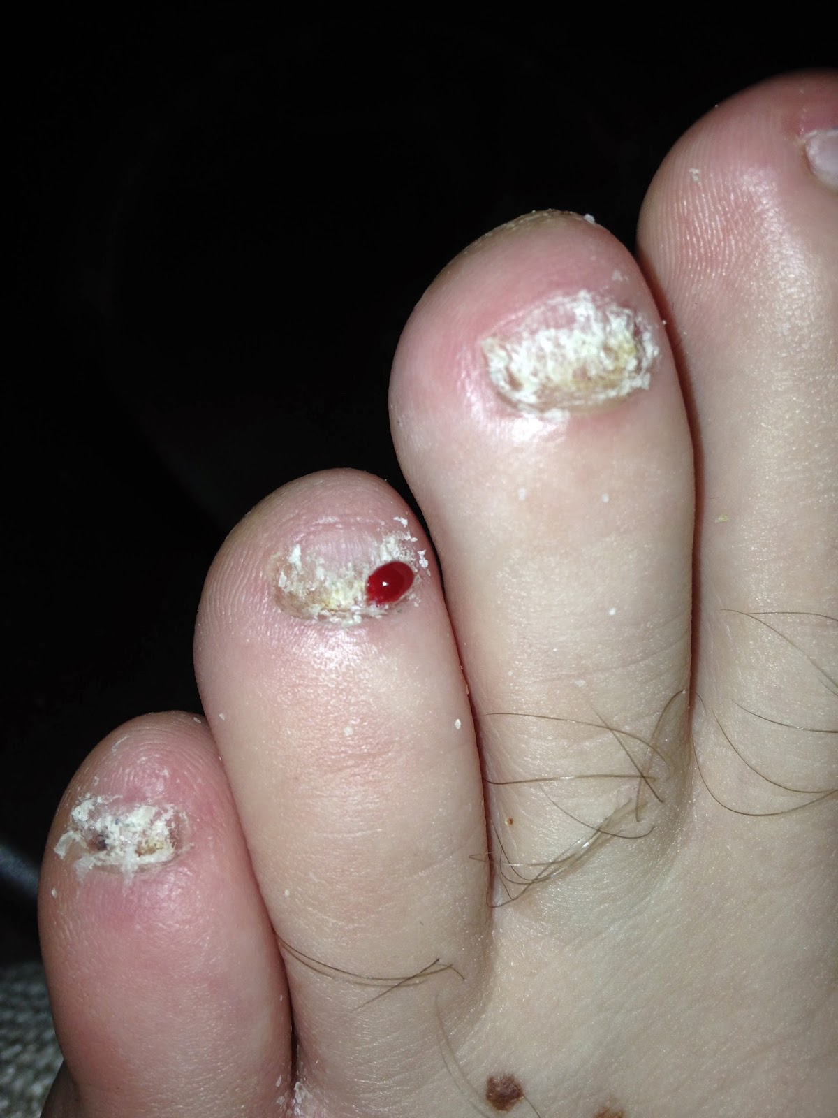 My Journey with Vicks VapoRub for Toenail Fungus Day 41 of Vicks