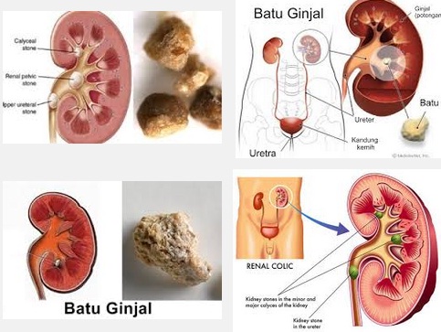 Bahaya Penyakit Batu Ginjal Bahaya Penyakit Batu Ginjal